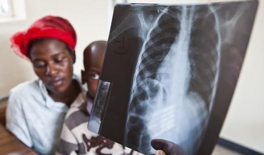 Quel symptôme de la tuberculose chez les enfants est considéré comme le début de la maladie?