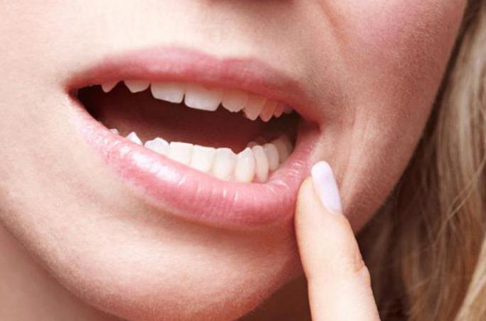 Elyners: avis sur le kappa pour aligner les dents